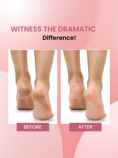 Foot Callus Remover